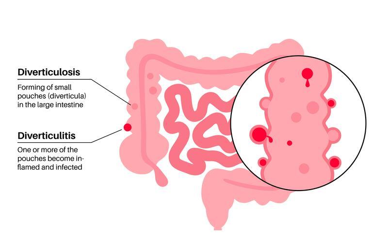 Diverticular Disease Anatomy