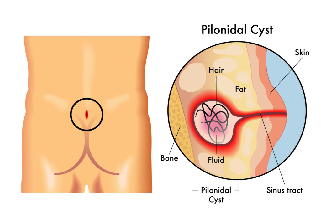 Pilonidal Cyst